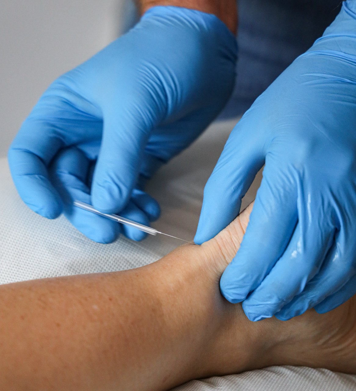 5 Reasons to Try Dry Needling Therapy for Pain Relief