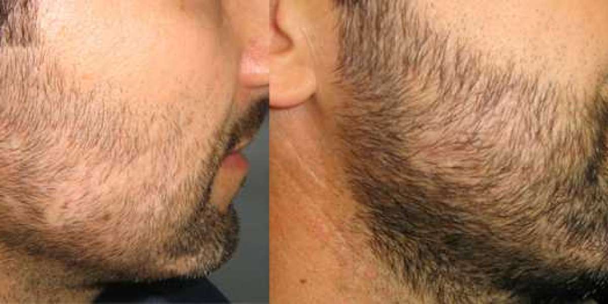 Are You Looking For A Beard Transplant In Palm Desert?