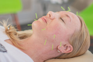 Cosmetic Acupuncture Microneedling Nano needling – Albuquerque