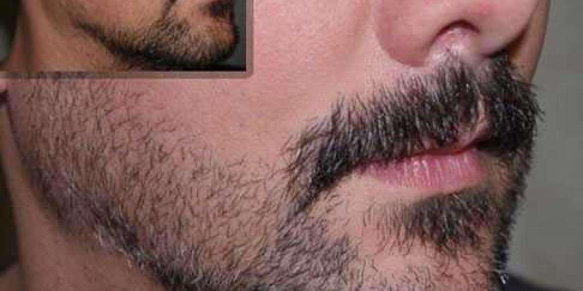 How much does a facial hair transplant cost?