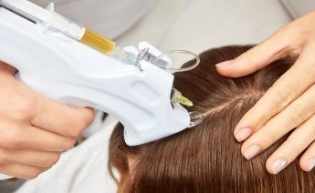 PRP Hair Treatment Success Rate | Dermcos