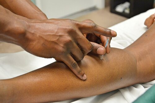Dry Needling Physiotherapy Services in Langley