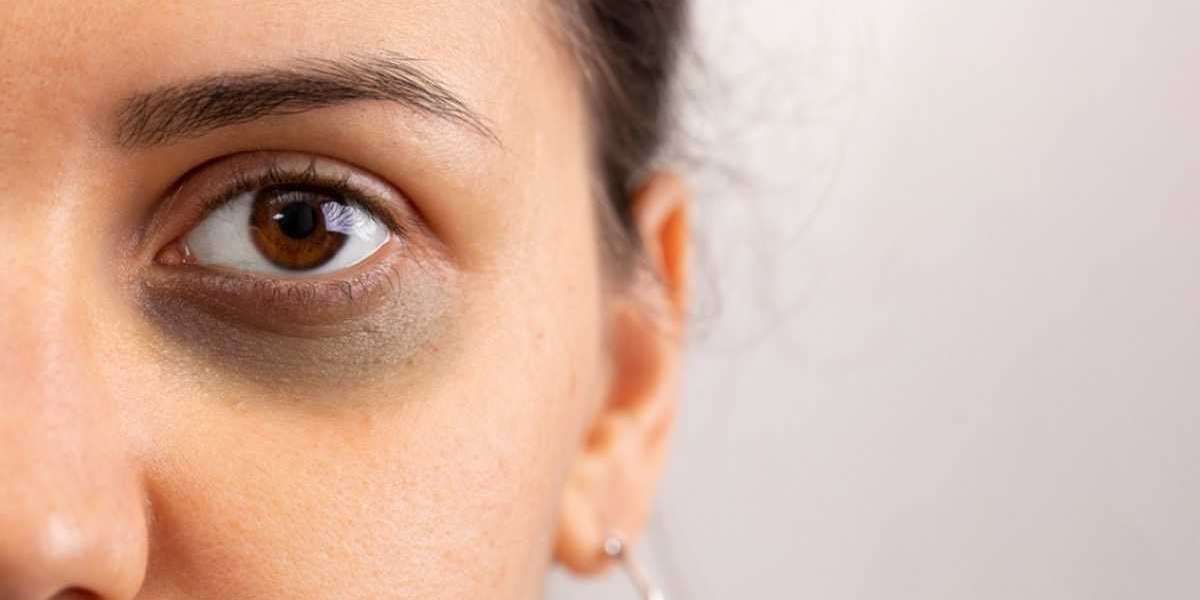 Dark Circles Treatment - How to Get Rid of Dark Circles?