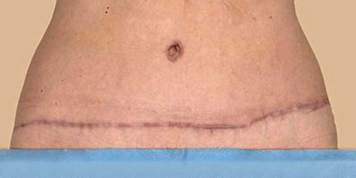 What are the Top 5 Benefits and Disadvantages of a Tummy Tuck Surgery?