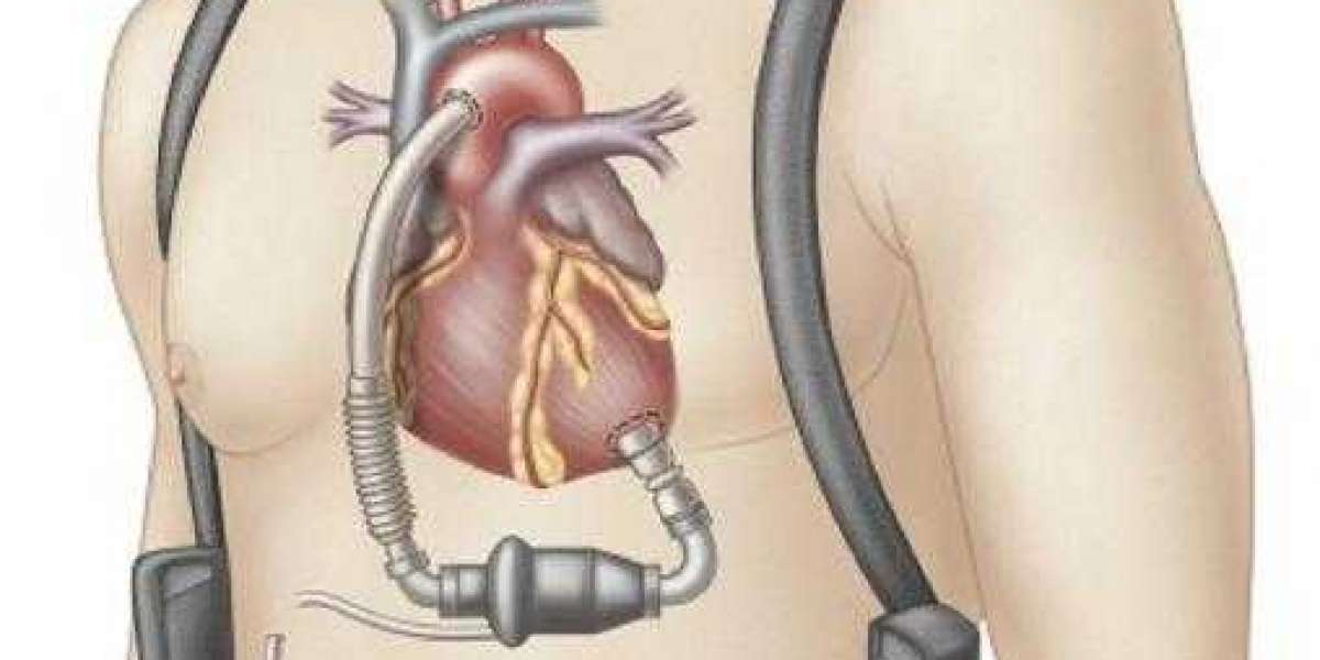 Adult Ventricular Assist Device Market Expected to Expand at a Steady 2022-2030