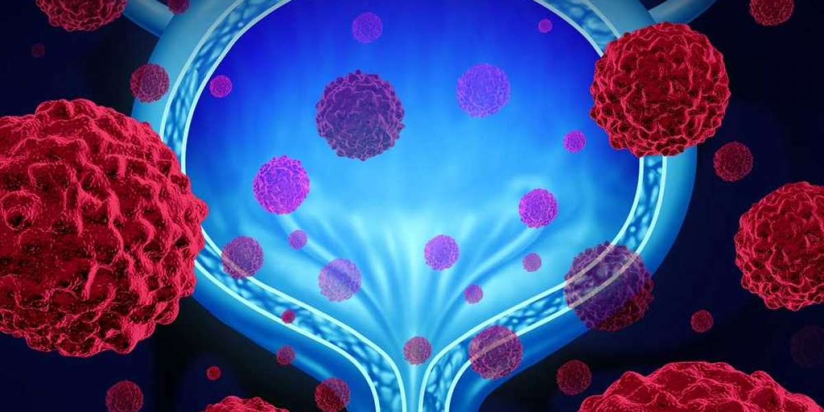 Urothelial Carcinoma Treatment Market Research 2022 - Growth, Trends, Outlook and Future Scope Analysis 2031