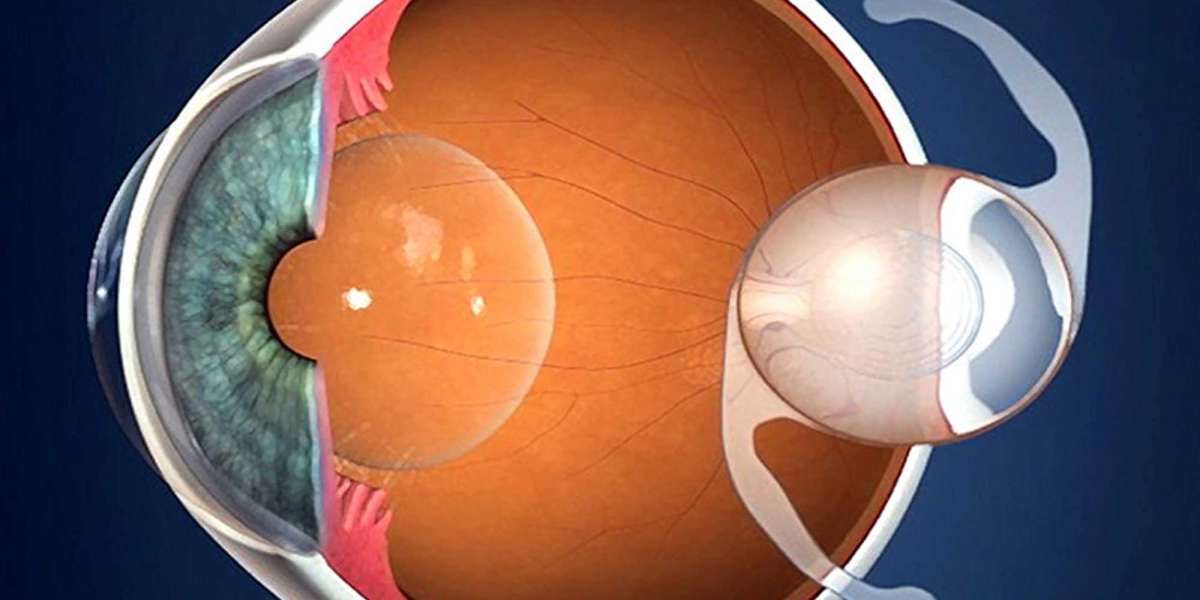 Global Intraocular Lens Market Research and Analysis 2022–2030: Industry Insights on Geographical Competition of Top Key