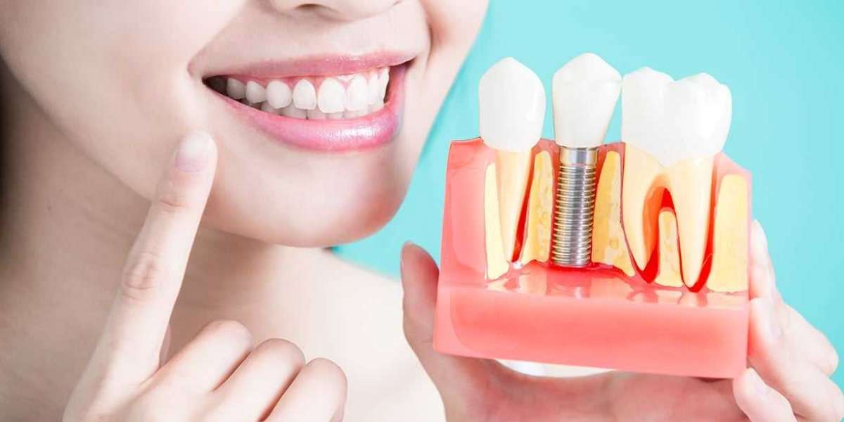 What Is Dental Implant? How Do Dental Implants Work?