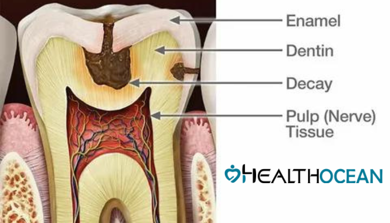 Rotten Teeth:Common dental hygiene problems - Health Ocean