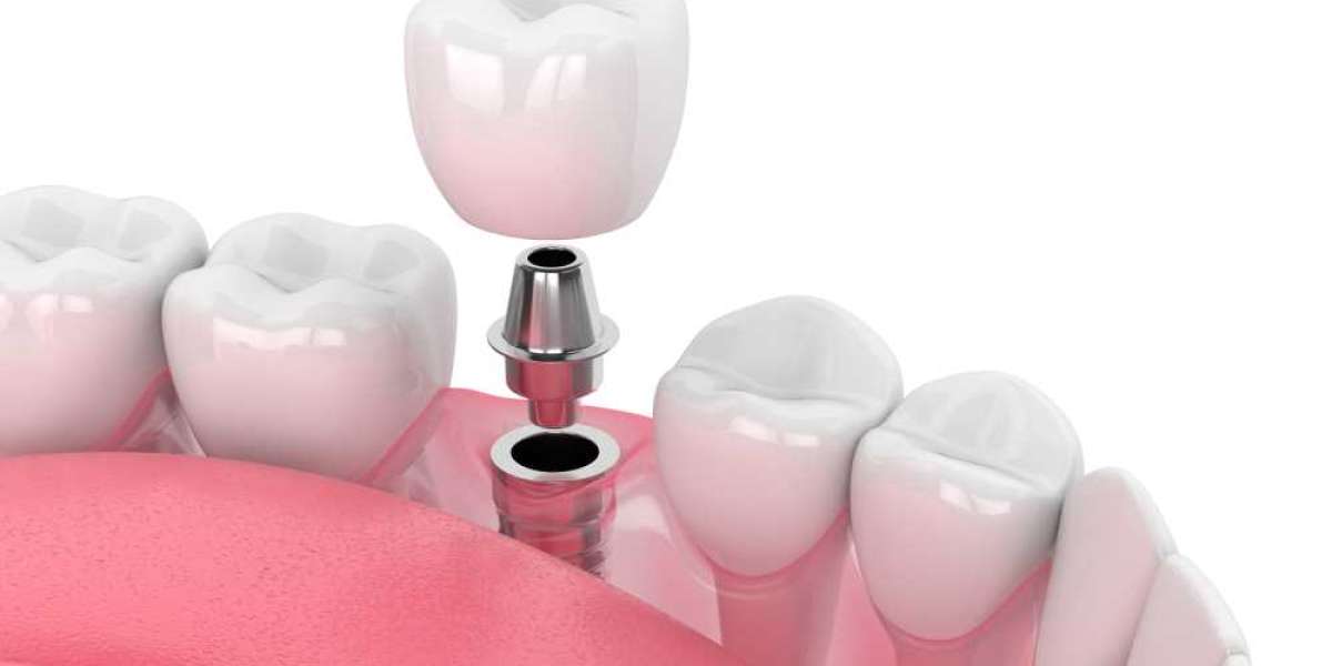Dental Implants - Discover Dental Implant Options