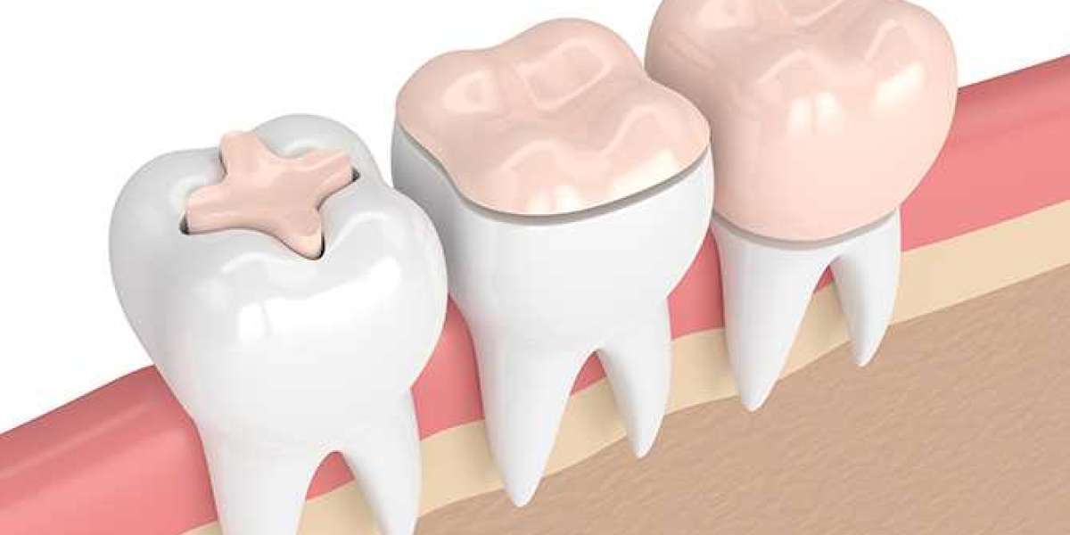 Restorative Dentistry Market Size is Expected to total US$ 25,904.1 million by 2030