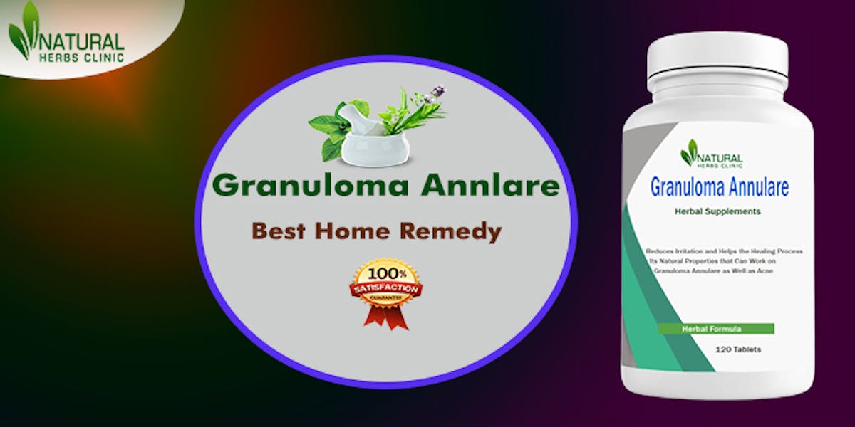 How to Get Rid of My Granuloma  Annulare Using Natural Remedies