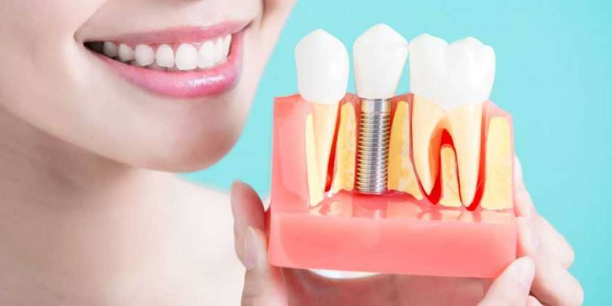 Dental Implants: Costing & Factors