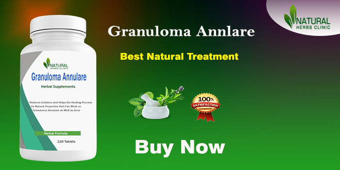 Read How I Get Natural Treatment for Granuloma Annulare