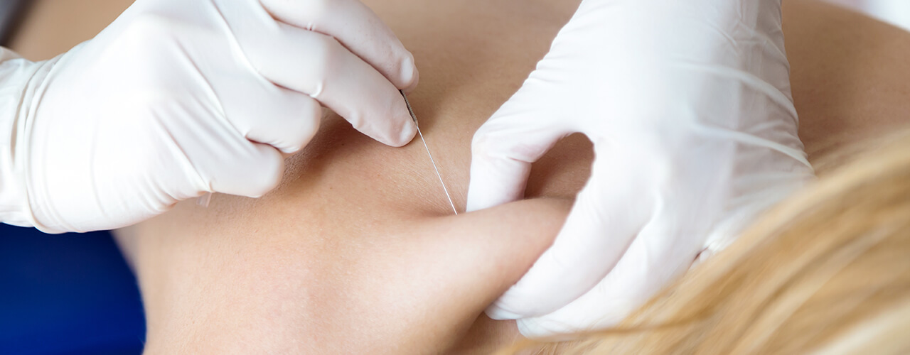 The Benefits of Dry Needling Physiotherapy Services for Pain Relief — Population Journal