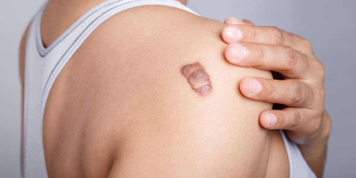 New Frontiers in Keloid Therapy: Promising Breakthroughs in Scar Reduction