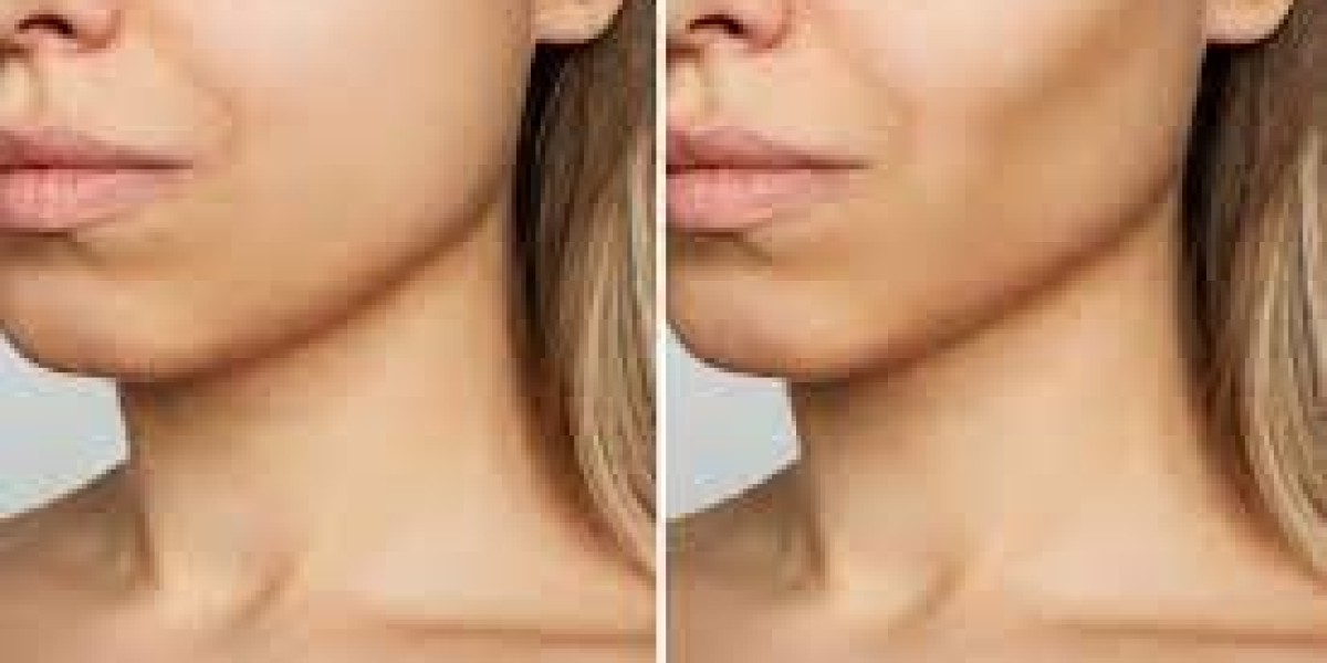 A Journey to Facial Harmony: Buccal Fat Removal Benefits