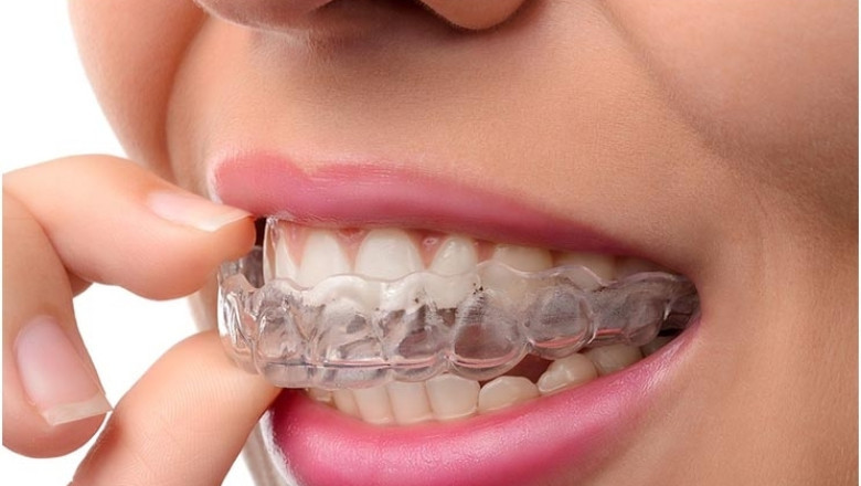 What Are Clear Aligners? | Times Square Reporter