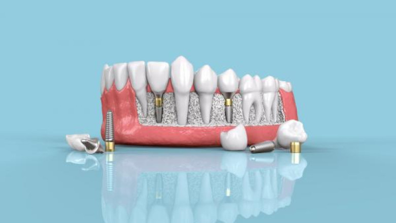 The Ultimate Guide to Understanding the Cost of Dental Implants in Louisville, KY | Times Square Reporter