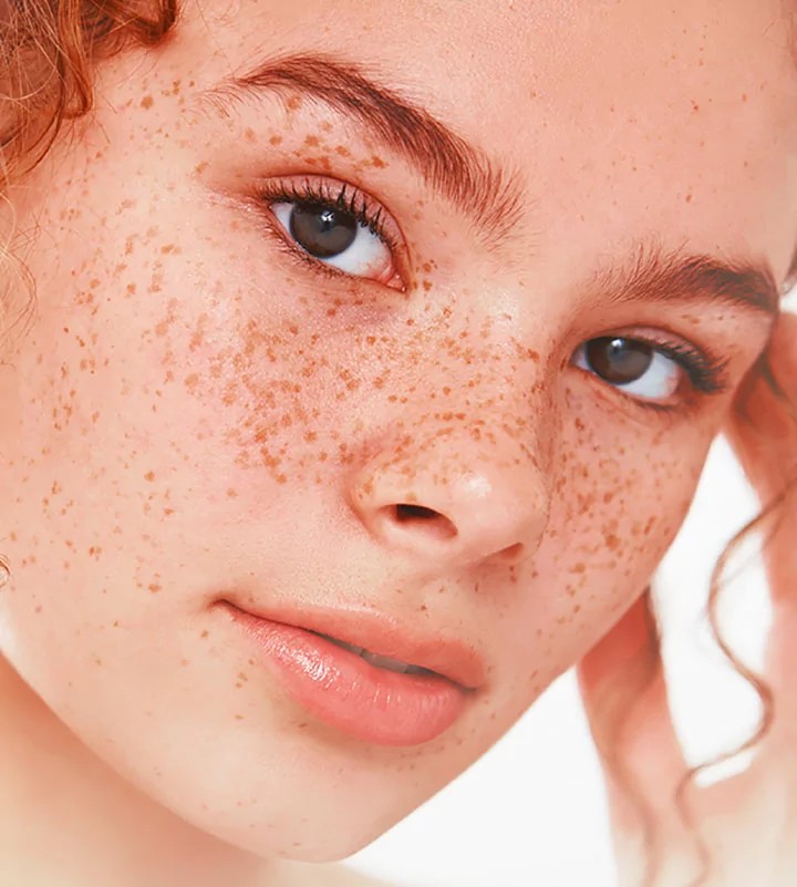 What is the cause of Skin Hyperpigmentation and how to deal with