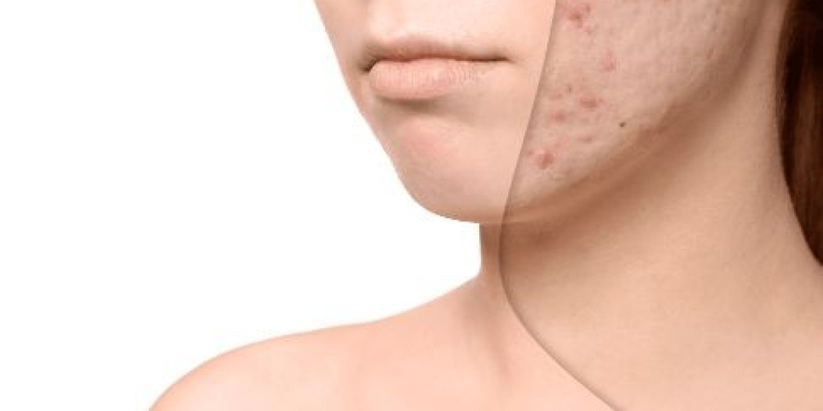 Banish Hyperpigmentation: Discover Effective Treatments at Topelectrolysis NYC