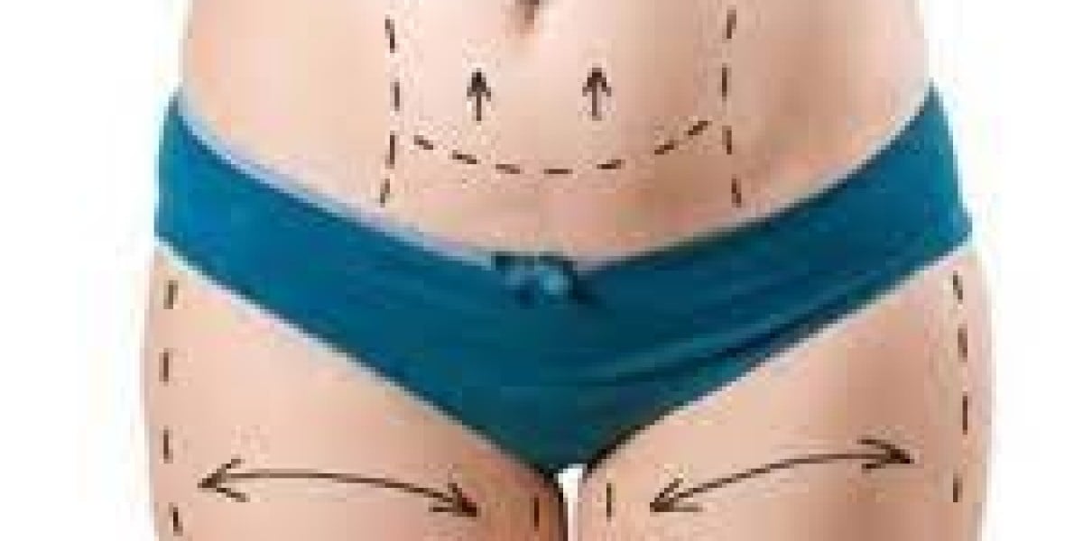  Tummy Tuck: Redefining Your Abdominal Contours