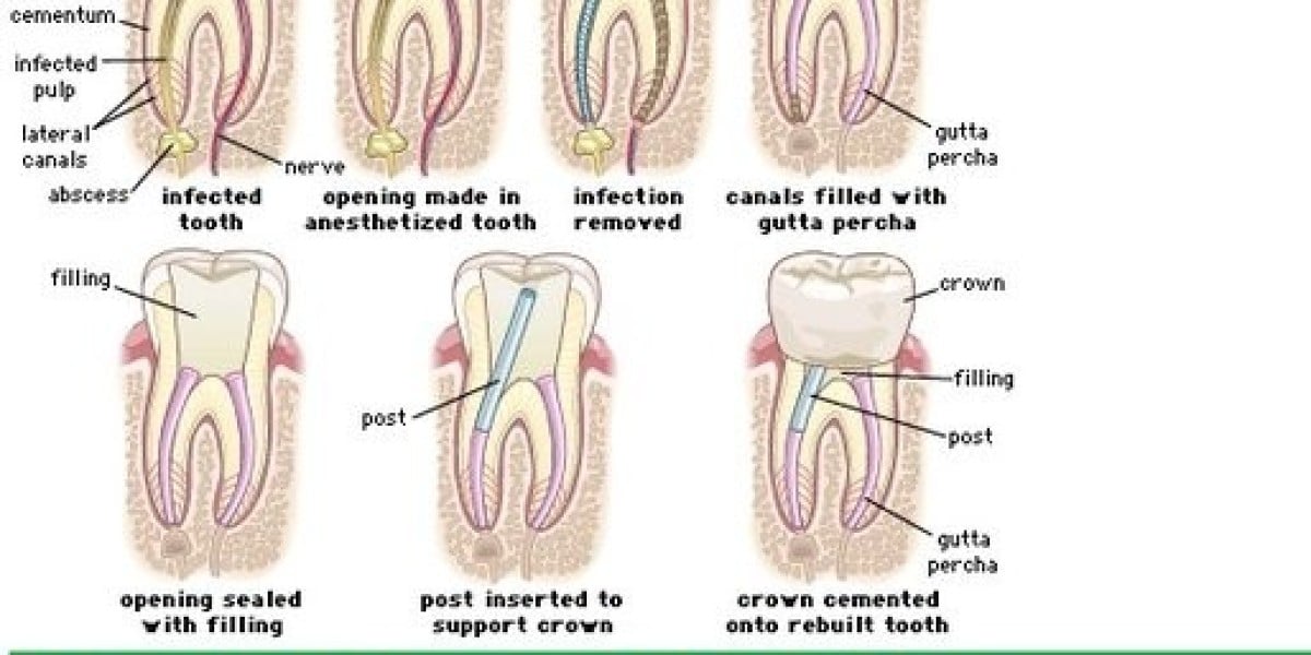 What are root canal treatment steps?