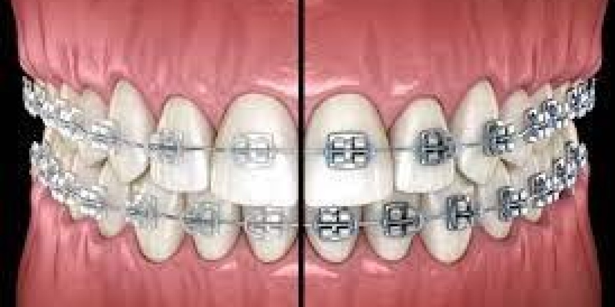 Experience the Difference with Ceramic Braces