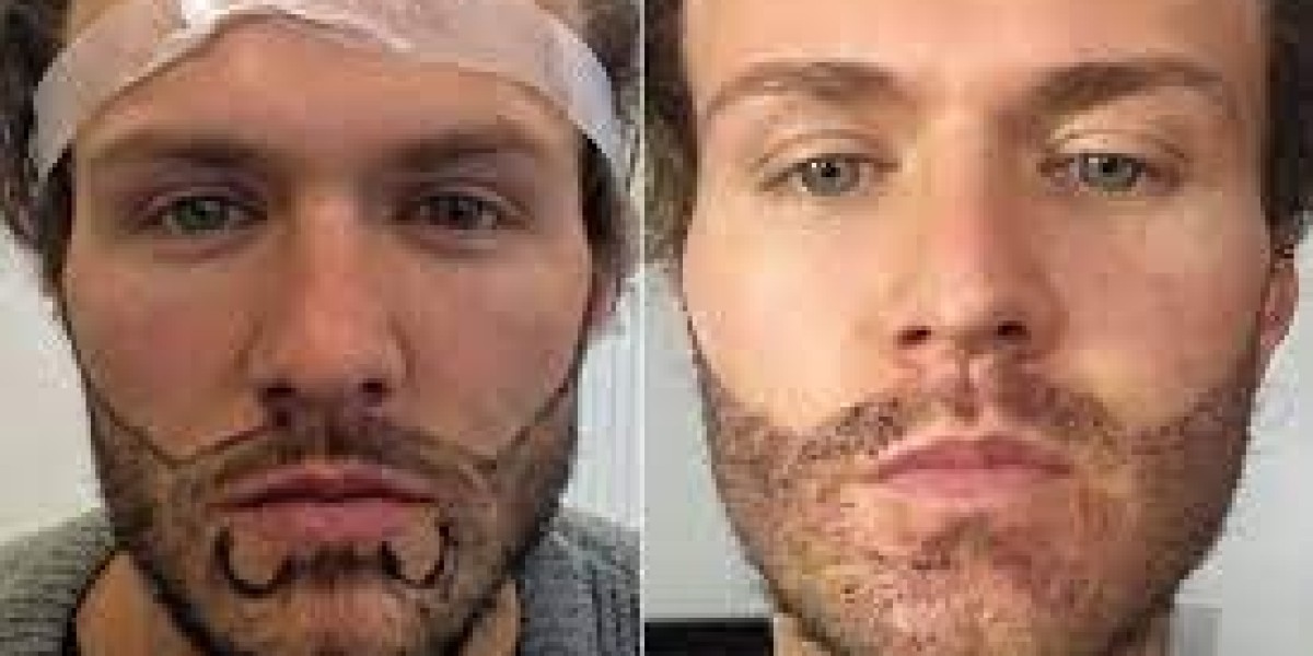 Boosting Your Facial Hair Game: Beard Hair Transplantation