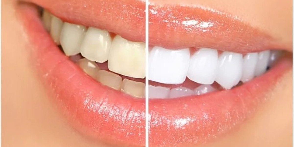 Smile with Confidence: The Magic of Teeth Whitening Unveiled