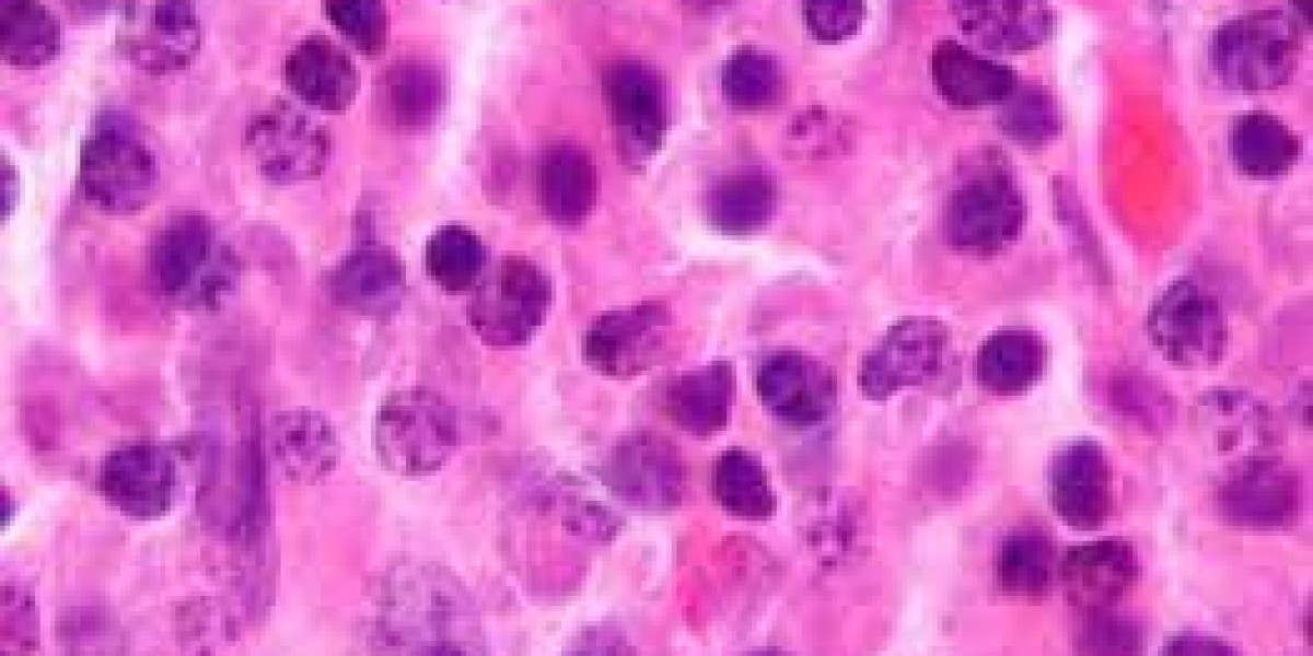 Plasmacytoma Market Analysis Report 2023 Along with Statistics, Forecasts till 2033