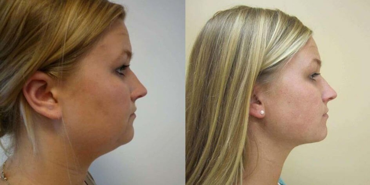 Elevate Your Beauty: Discover the Benefits of a Neck Lift