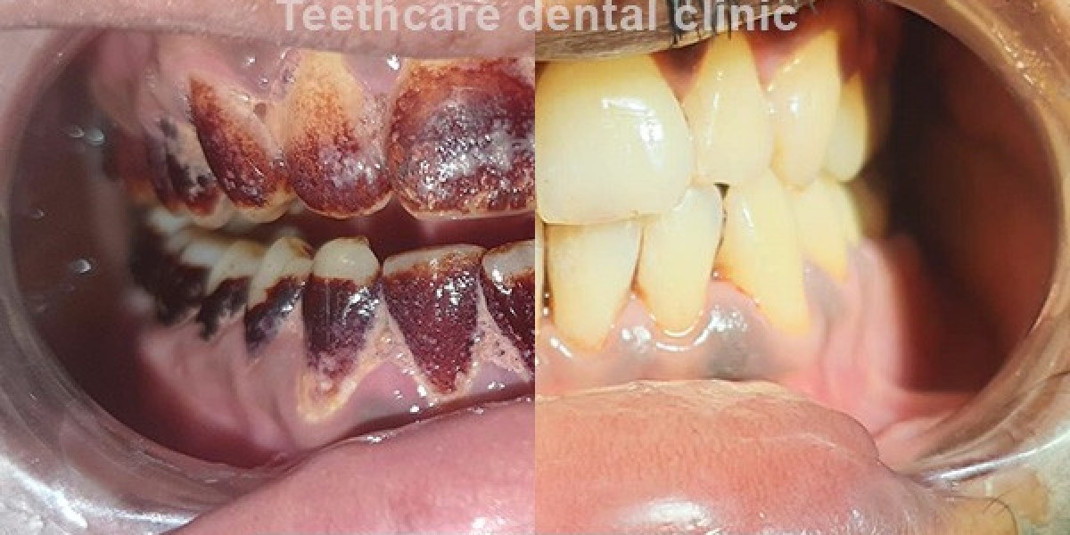 Does Teeth Whitening Work?