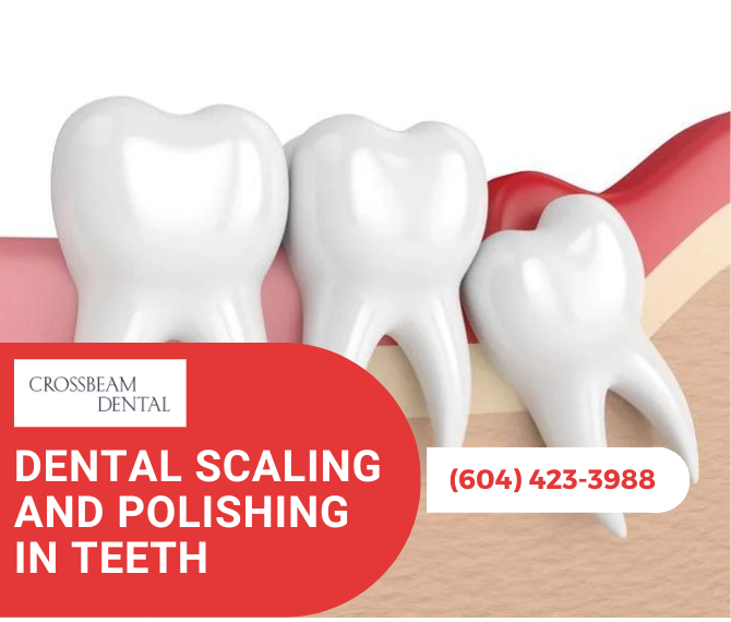 Enhance Your Dental Health and Confidence with Dental Scaling and Polishing