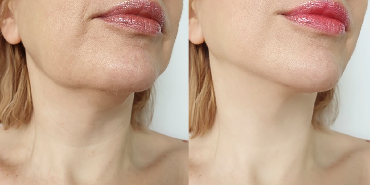  Shape Your Face: Chin Liposuction Techniques for Facial Harmony