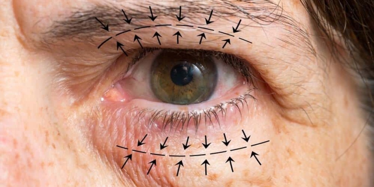 Embrace Your Unique Sparkle: Unveiling Eyelid Surgery