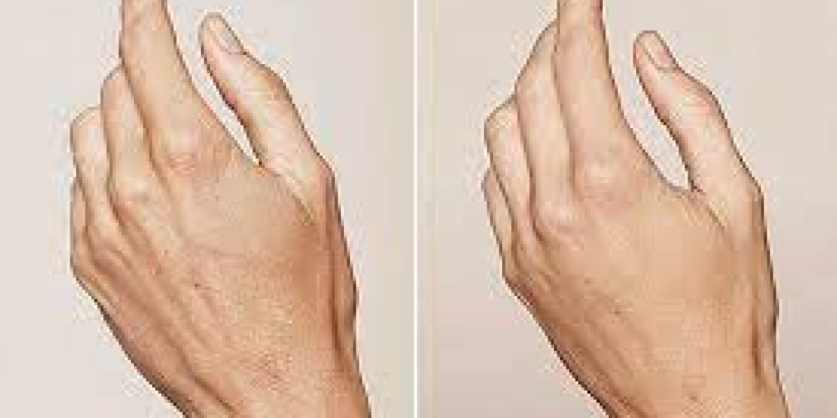 Hand Rejuvenation Essentials: Tips for Ageless Hands