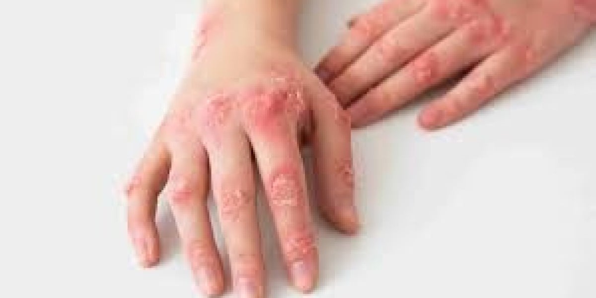  Eczema and the Gut: The Connection and Treatment Approaches