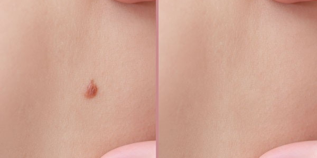 Is it Possible to Permanently Remove Moles?