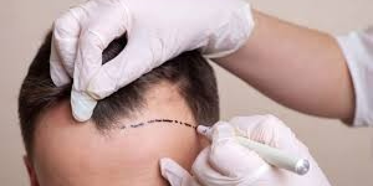 Preserving Youth: Hair Transplantation for Aging Individuals