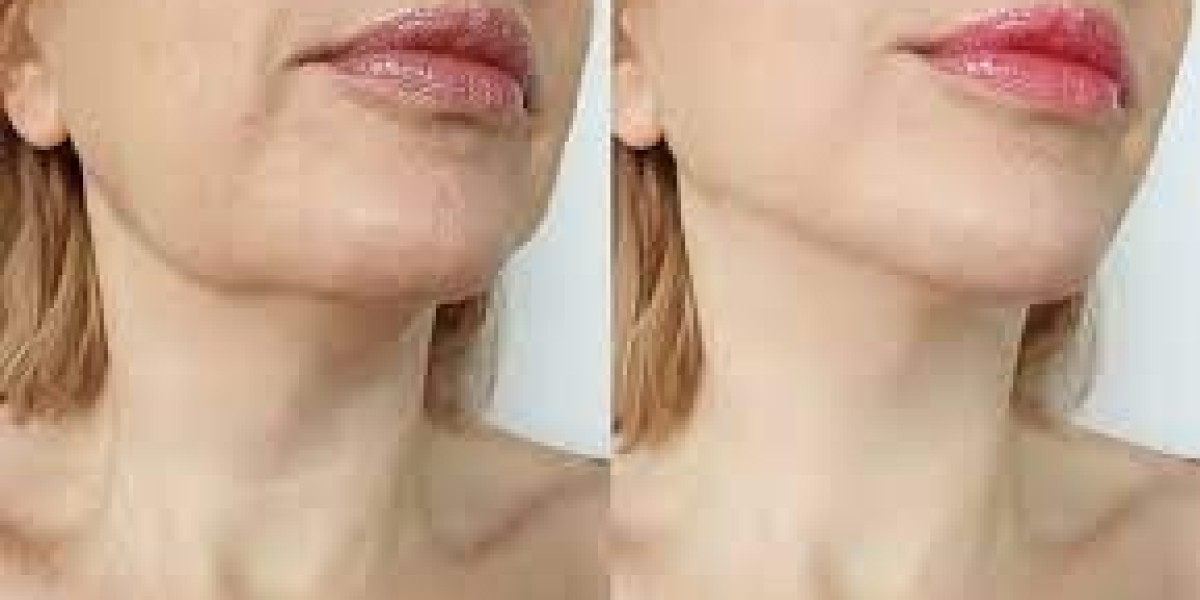 Sculpted Sophistication: All About Chin Liposuction