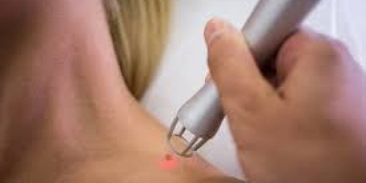Effortless Beauty: Skin Tag Removal Techniques That Work