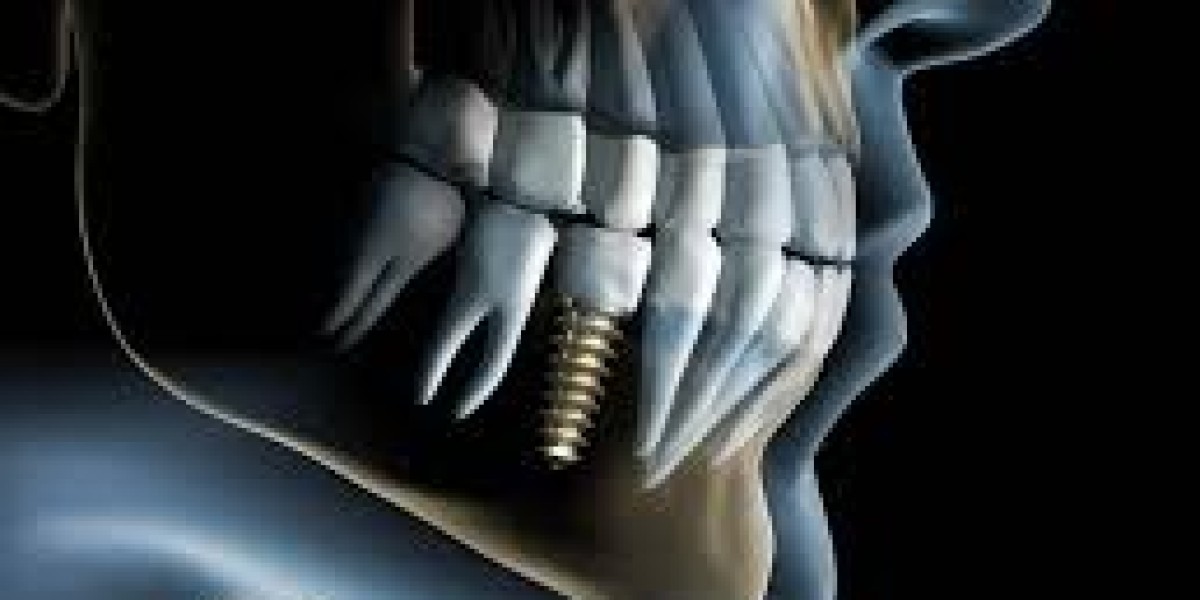Beyond Dentures: Exploring Dental Implant Surgery for Oral Rehabilitation