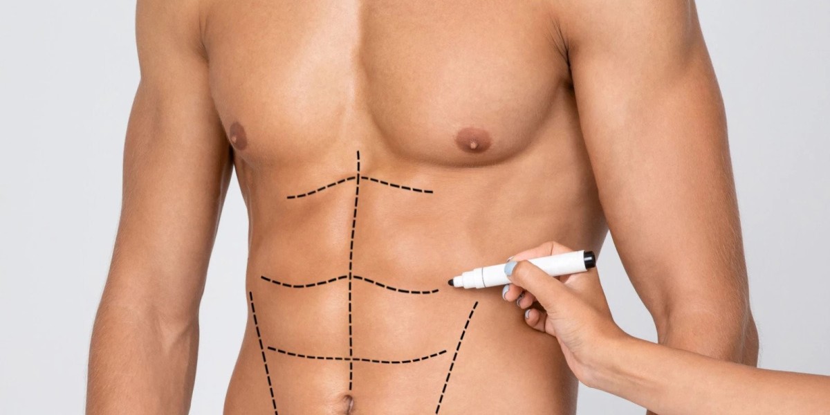 Comparing Tummy Tuck Costs: Tips for Affordable Surgery