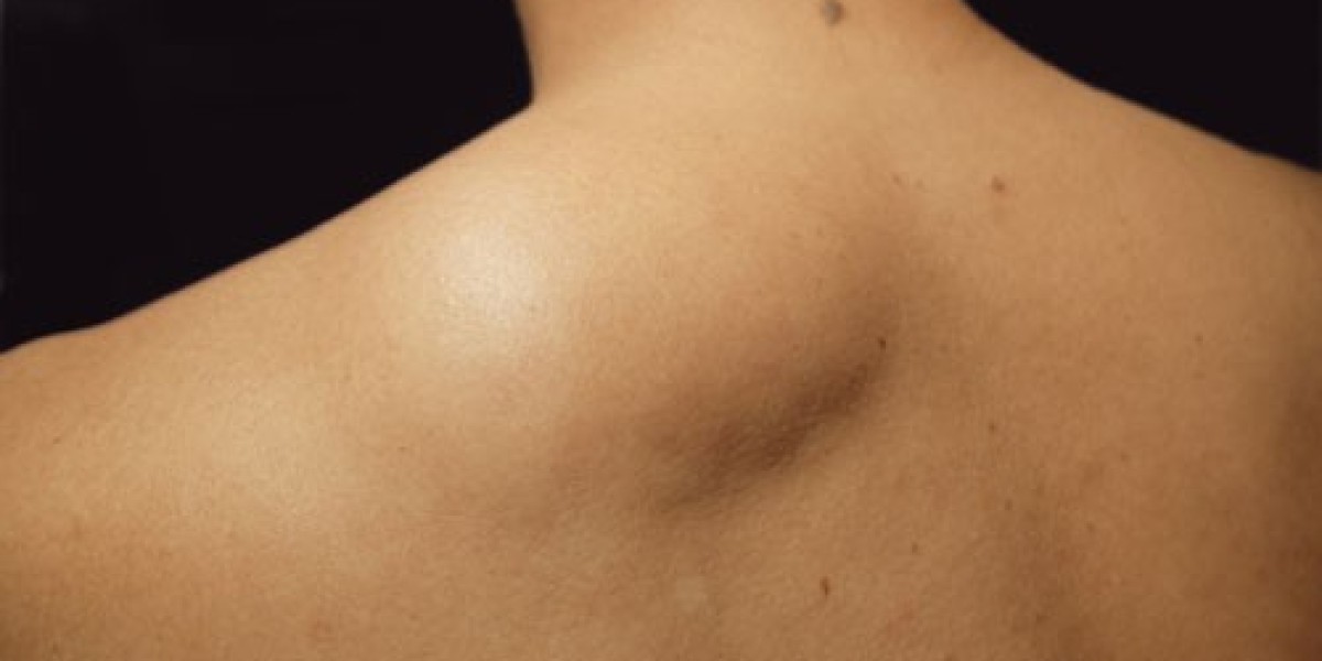 Lipoma Removal Scars: How to Minimize and Manage Them