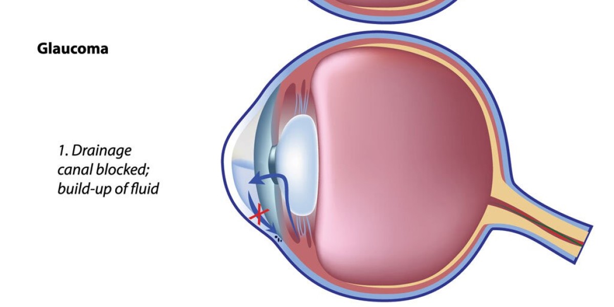 Glaucoma Treatment Market Size, Share, Growth and Analysis 2022 Forecast to 2032.
