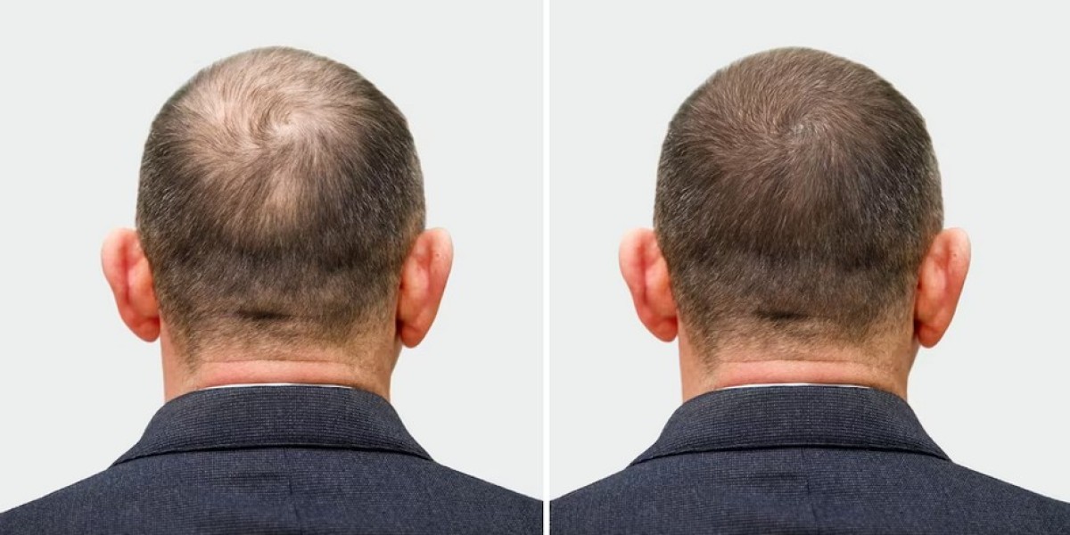 Transforming Lives: Jaw-Dropping Hair Transplant Turkey Before and After