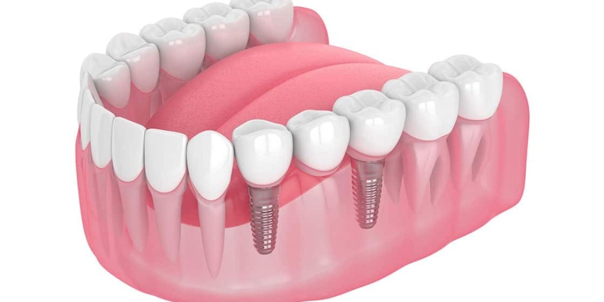 Dental Implants on a Budget: Tips and Tricks