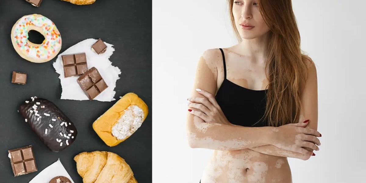 Foods You Should Avoid If You Have Vitiligo