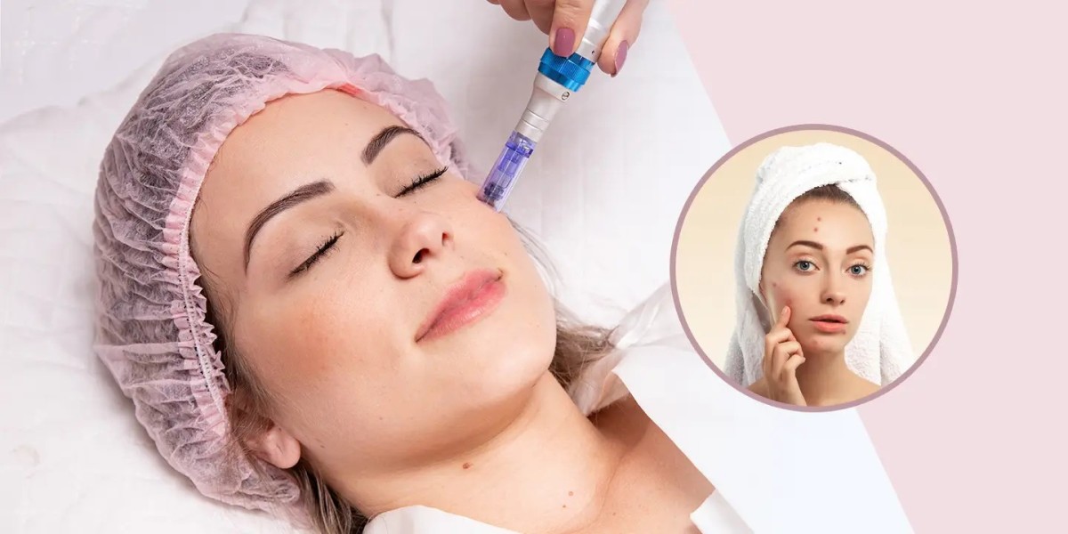 Dealing with Acne Scars? Here’s How Dermapen Microneedling Can Help